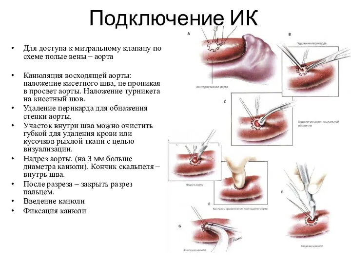 Подключение ИК Для доступа к митральному клапану по схеме полые вены –