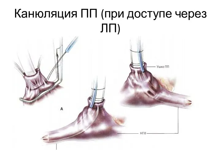 Канюляция ПП (при доступе через ЛП)