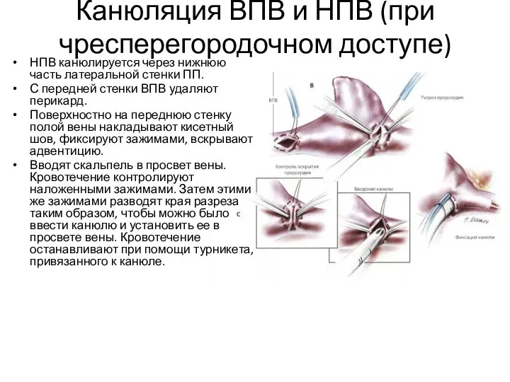 Канюляция ВПВ и НПВ (при чресперегородочном доступе) НПВ канюлируется через нижнюю часть