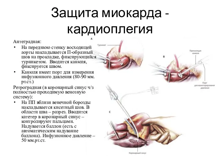 Защита миокарда - кардиоплегия Антеградная: На переднюю стенку восходящей аорты накладывается П-образный