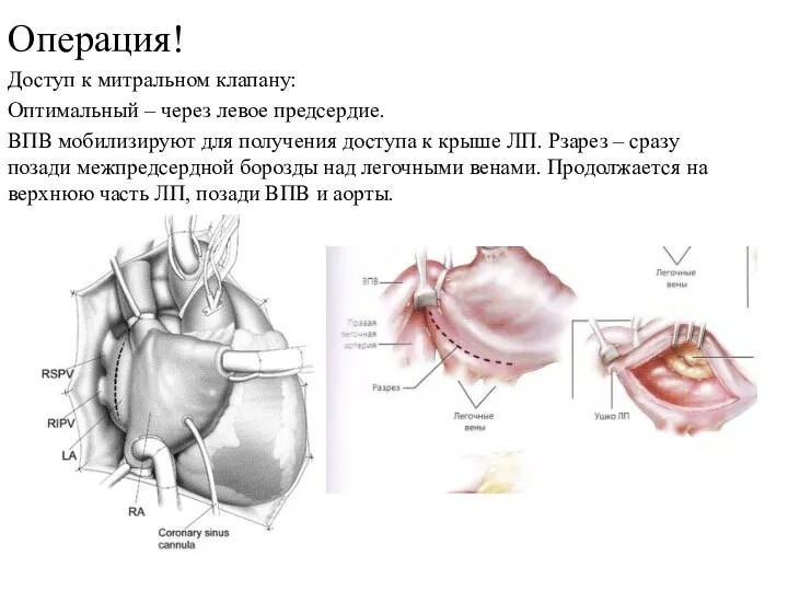 Операция! Доступ к митральном клапану: Оптимальный – через левое предсердие. ВПВ мобилизируют