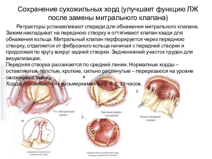 Сохранение сухожильных хорд (улучшает функцию ЛЖ после замены митрального клапана) Ретракторы устанавливают