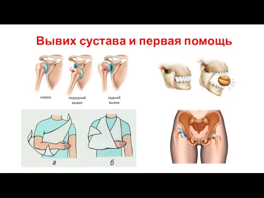 Вывих сустава и первая помощь