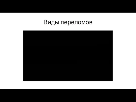 Виды переломов