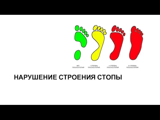 НАРУШЕНИЕ СТРОЕНИЯ СТОПЫ