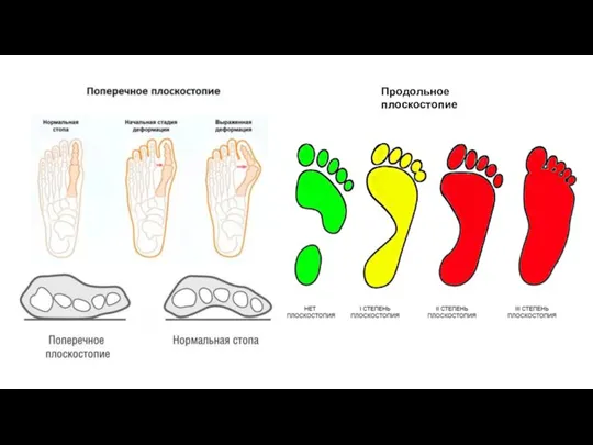 Продольное плоскостопие