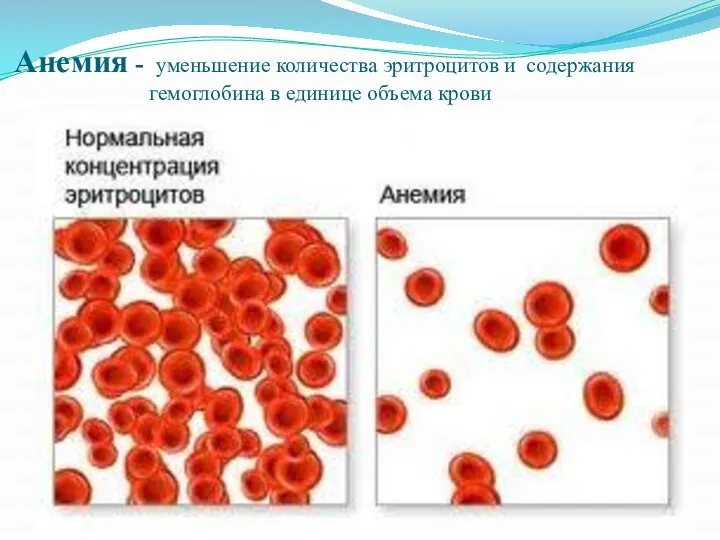 Анемия - уменьшение количества эритроцитов и содержания гемоглобина в единице объема крови