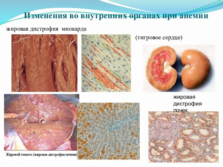Изменения во внутренних органах при анемии жировая дистрофия миокарда (тигровое сердце) жировая дистрофия почек