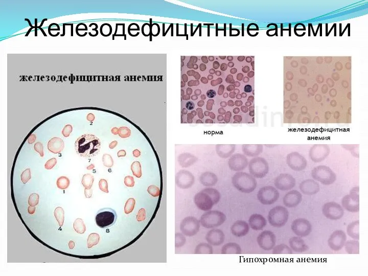 Железодефицитные анемии Гипохромная анемия