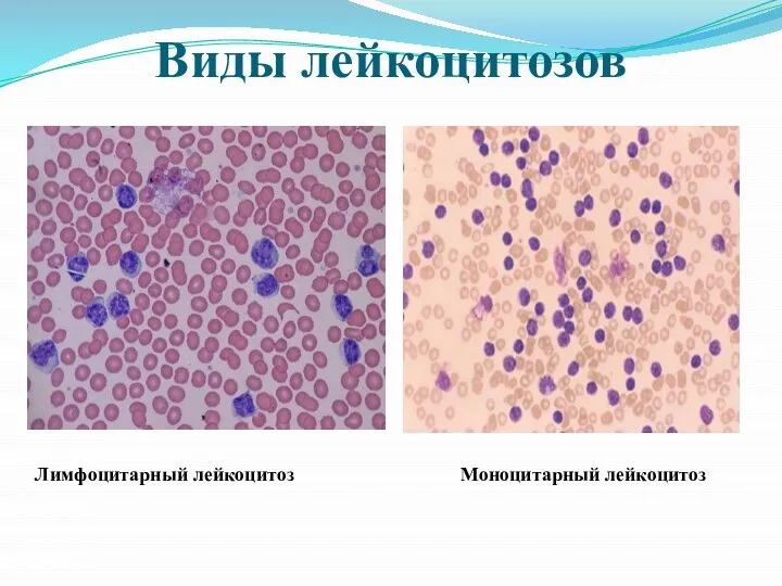 Виды лейкоцитозов Лимфоцитарный лейкоцитоз Моноцитарный лейкоцитоз