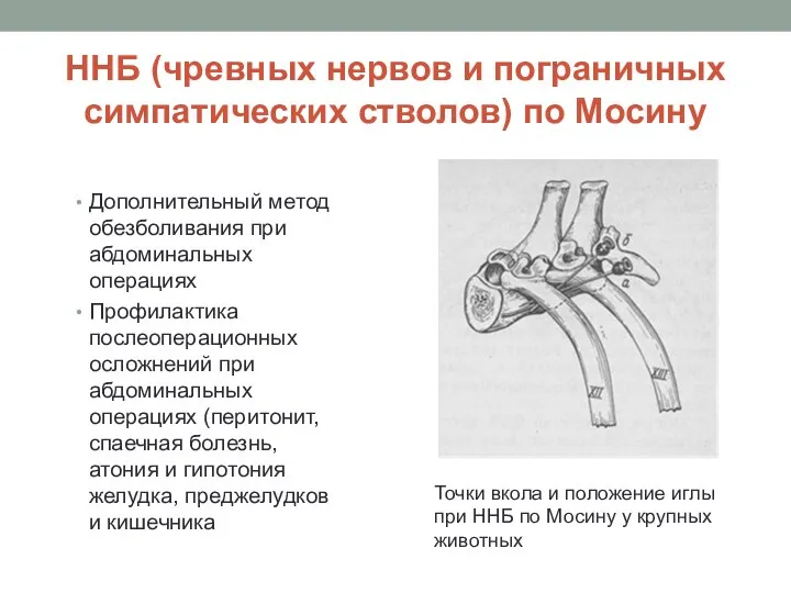 ННБ (чревных нервов и пограничных симпатических стволов) по Мосину Дополнительный метод обезболивания