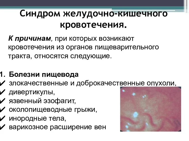 Синдром желудочно-кишечного кровотечения. К причинам, при которых возникают кровотечения из органов пищеварительного