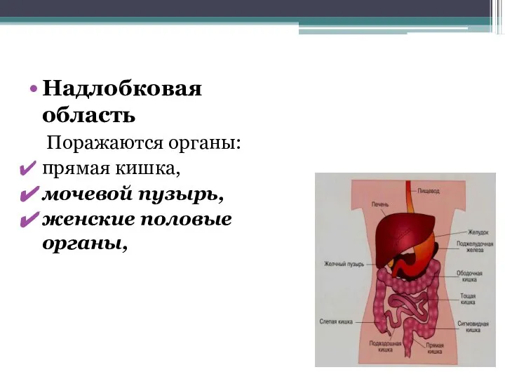 Надлобковая область Поражаются органы: прямая кишка, мочевой пузырь, женские половые органы,