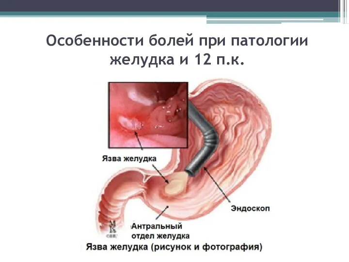 Особенности болей при патологии желудка и 12 п.к.