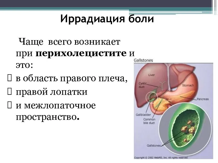 Иррадиация боли Чаще всего возникает при перихолецистите и это: в область правого
