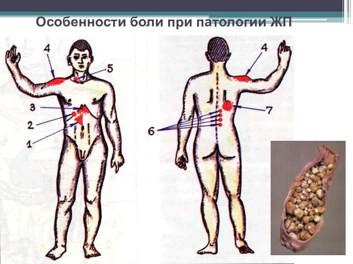 Особенности боли при патологии ЖП