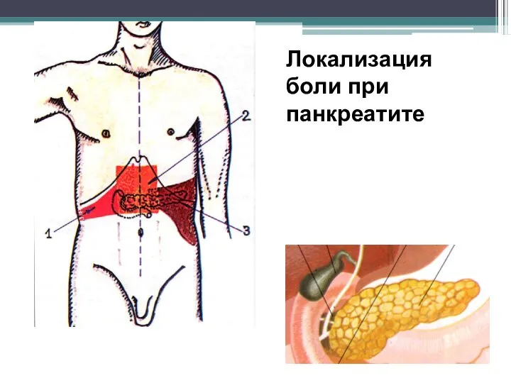 Локализация боли при панкреатите