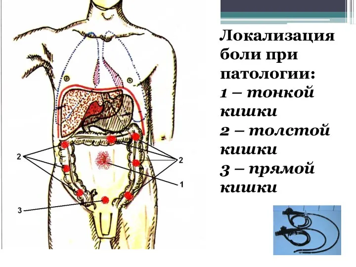 Локализация боли при патологии: 1 – тонкой кишки 2 – толстой кишки 3 – прямой кишки