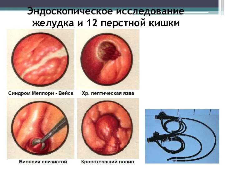 Эндоскопическое исследование желудка и 12 перстной кишки