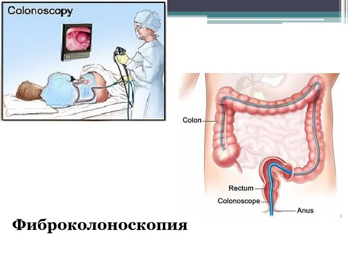 Фиброколоноскопия