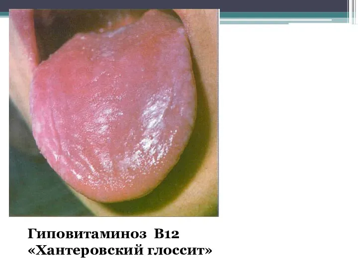 Гиповитаминоз В12 «Хантеровский глоссит»