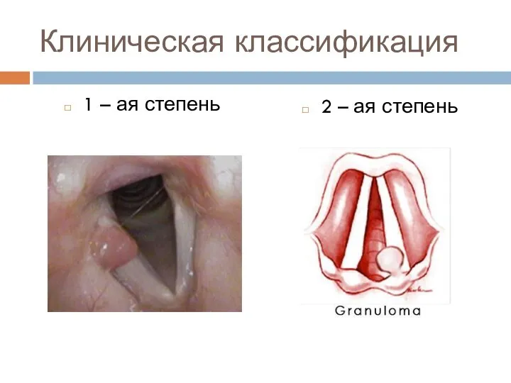 Клиническая классификация 1 – ая степень 2 – ая степень