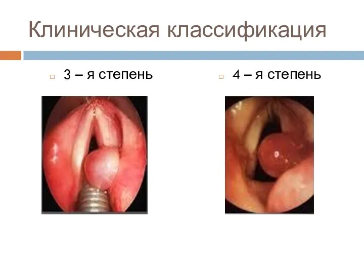 Клиническая классификация 3 – я степень 4 – я степень