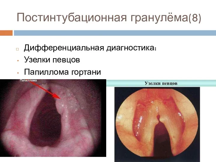 Постинтубационная гранулёма(8) Дифференциальная диагностика: Узелки певцов Папиллома гортани