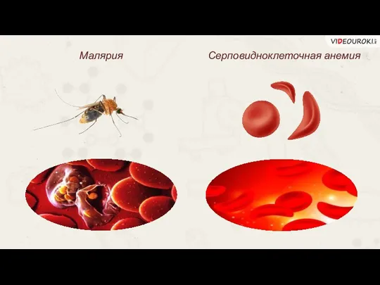Малярия Серповидноклеточная анемия