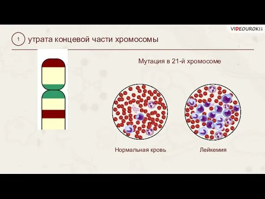 утрата концевой части хромосомы 1 Нормальная кровь Лейкемия Мутация в 21-й хромосоме