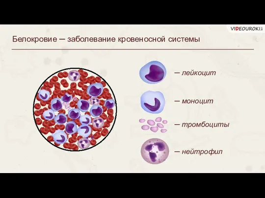 Белокровие ─ заболевание кровеносной системы ─ моноцит ─ тромбоциты ─ нейтрофил ─ лейкоцит