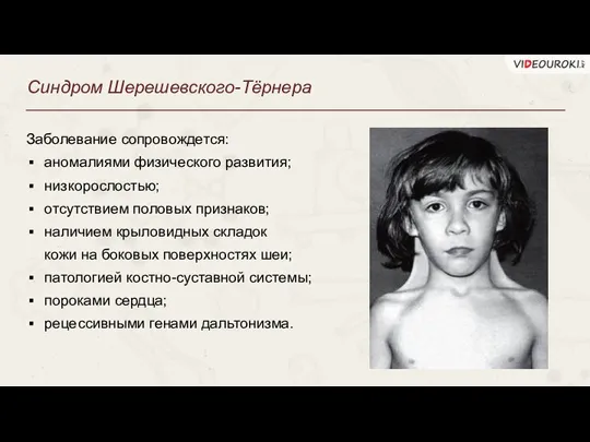 Синдром Шерешевского-Тёрнера Заболевание сопровождется: аномалиями физического развития; низкорослостью; отсутствием половых признаков; наличием