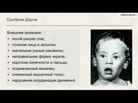Синдром Дауна Внешние признаки: косой разрез глаз; плоское лицо и затылок; маленькие