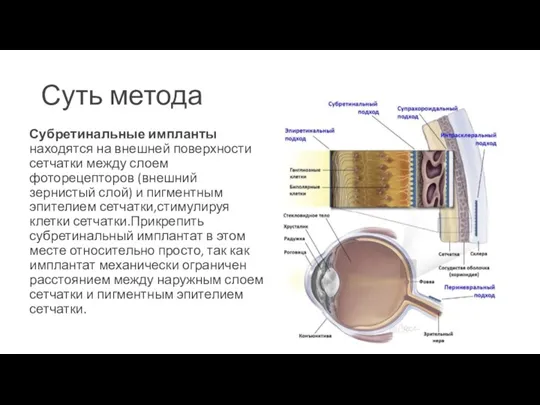 Суть метода Субретинальные импланты находятся на внешней поверхности сетчатки между слоем фоторецепторов