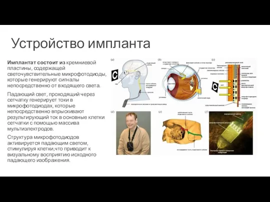 Устройство импланта Имплантат состоит из кремниевой пластины, содержащей светочувствительные микрофотодиоды, которые генерируют