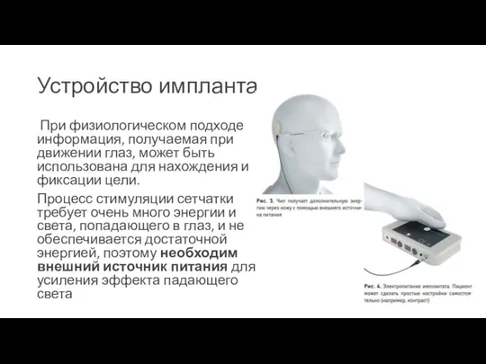 Устройство импланта При физиологическом подходе информация, получаемая при движении глаз, может быть