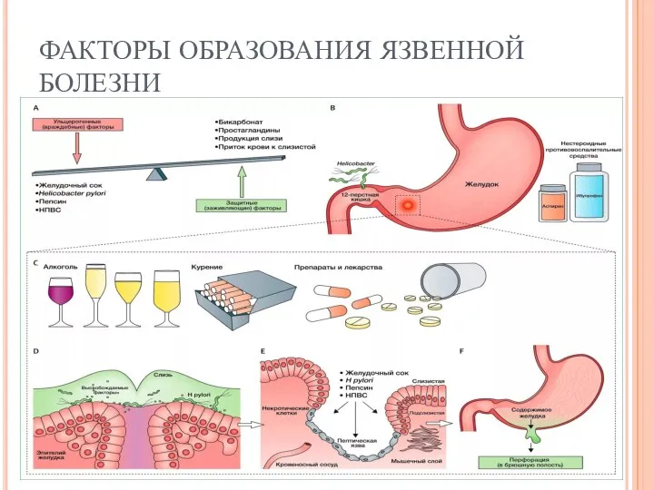 ФАКТОРЫ ОБРАЗОВАНИЯ ЯЗВЕННОЙ БОЛЕЗНИ