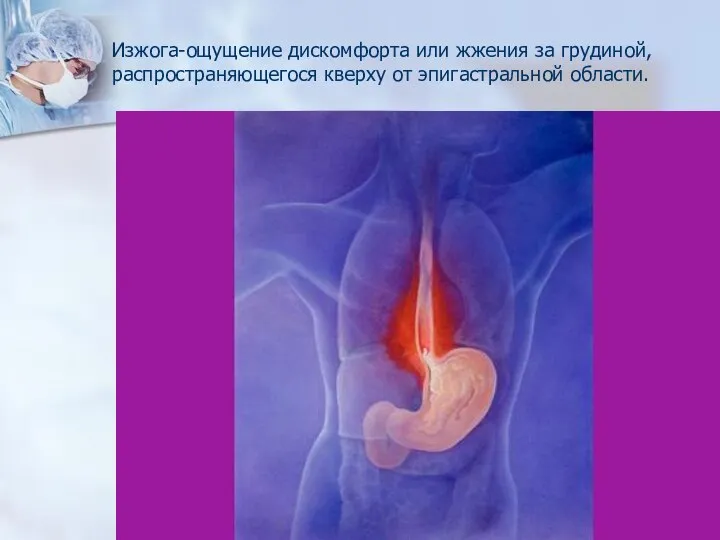 Изжога-ощущение дискомфорта или жжения за грудиной, распространяющегося кверху от эпигастральной области.