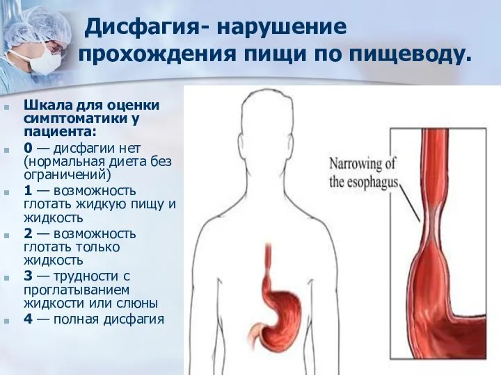 Дисфагия- нарушение прохождения пищи по пищеводу. Шкала для оценки симптоматики у пациента: