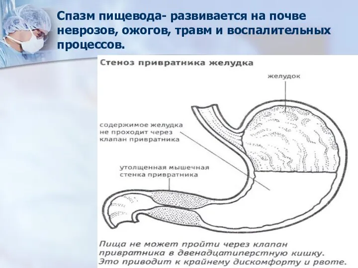 Спазм пищевода- развивается на почве неврозов, ожогов, травм и воспалительных процессов.