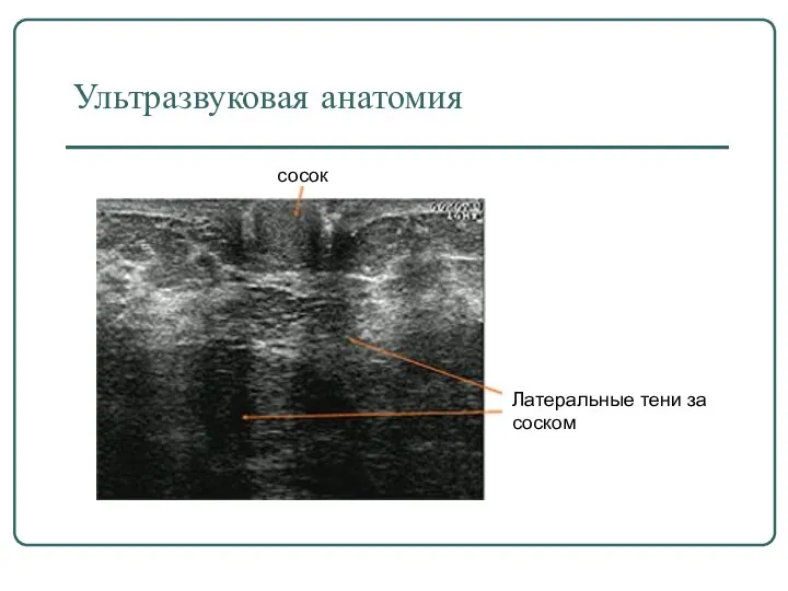 Ультразвуковая анатомия сосок Латеральные тени за соском