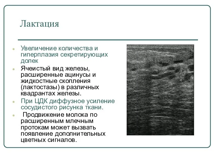 Лактация Увеличение количества и гиперплазия секретирующих долек Ячеистый вид железы, расширенные ацинусы