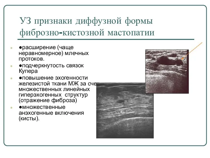 УЗ признаки диффузной формы фиброзно-кистозной мастопатии ●расширение (чаще неравномерное) млечных протоков. ●подчеркнутость