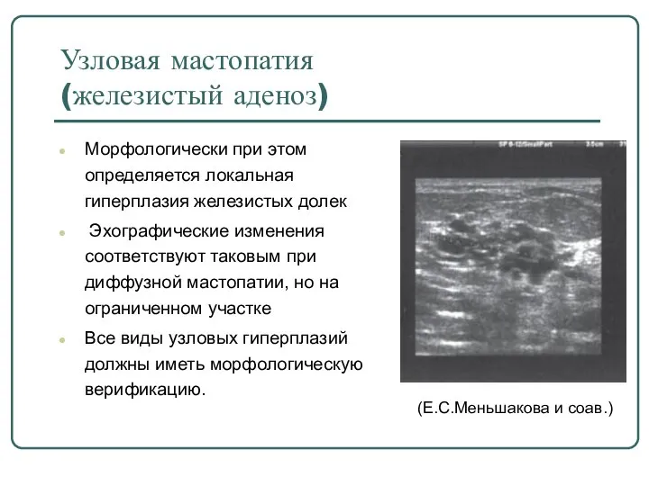 Узловая мастопатия (железистый аденоз) Морфологически при этом определяется локальная гиперплазия железистых долек