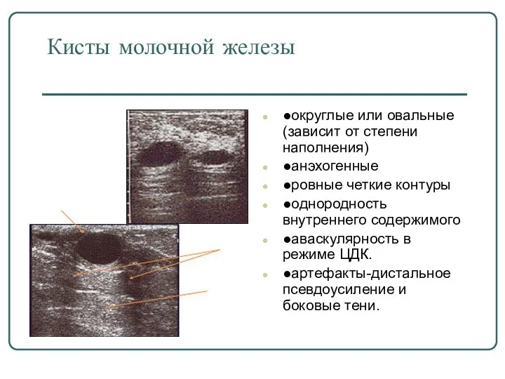 Кисты молочной железы ●округлые или овальные (зависит от степени наполнения) ●анэхогенные ●ровные