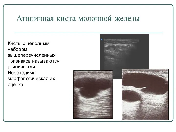 Атипичная киста молочной железы Кисты с неполным набором вышеперечисленных признаков называются атипичными. Необходима морфологическая их оценка