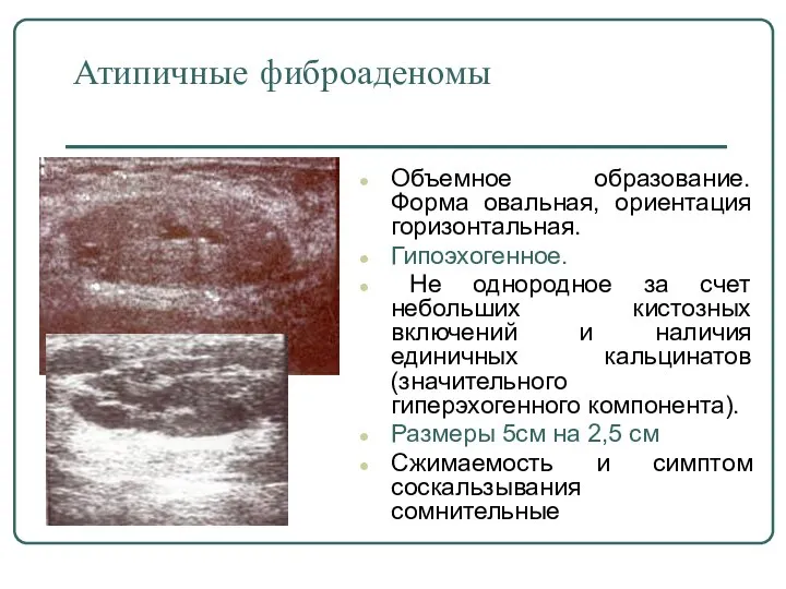 Атипичные фиброаденомы Объемное образование. Форма овальная, ориентация горизонтальная. Гипоэхогенное. Не однородное за