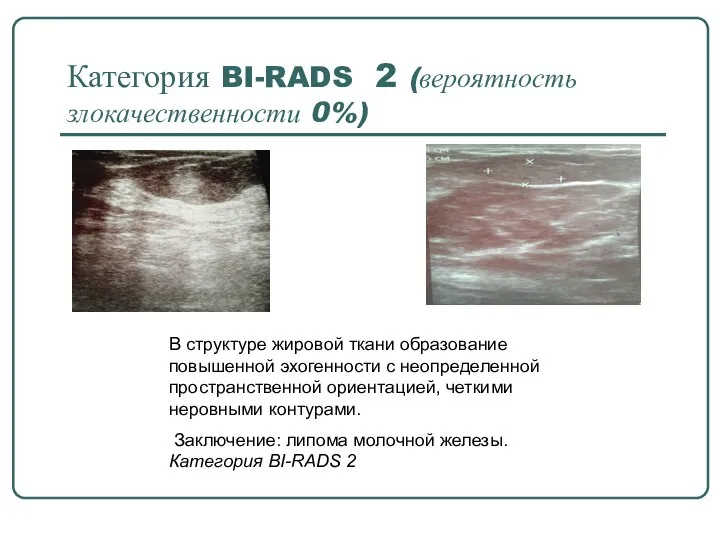 Категория BI-RADS 2 (вероятность злокачественности 0%) В структуре жировой ткани образование повышенной