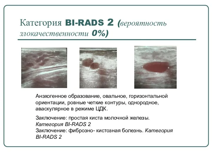 Категория BI-RADS 2 (вероятность злокачественности 0%) Анэхогенное образование, овальное, горизонтальной ориентации, ровные