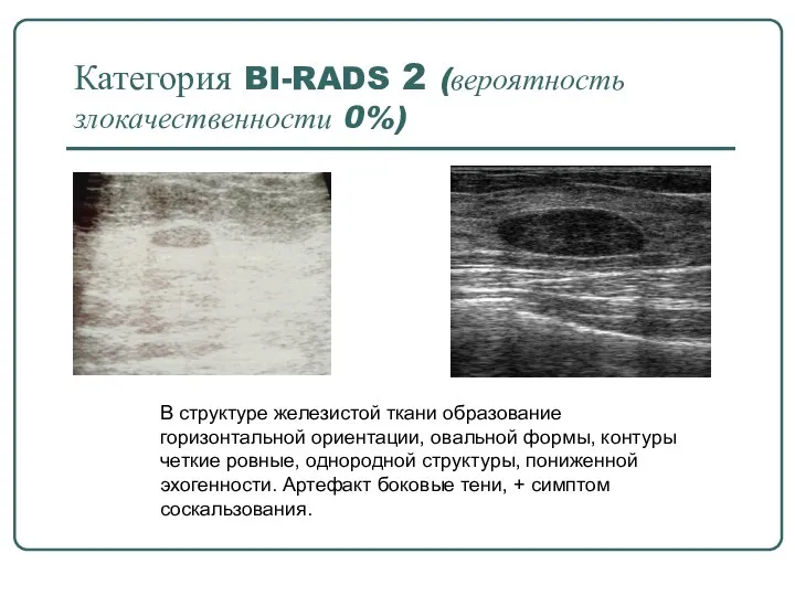 Категория BI-RADS 2 (вероятность злокачественности 0%) В структуре железистой ткани образование горизонтальной
